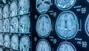 brain health